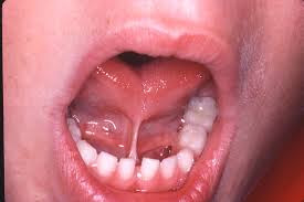 Tongue tie in a child
