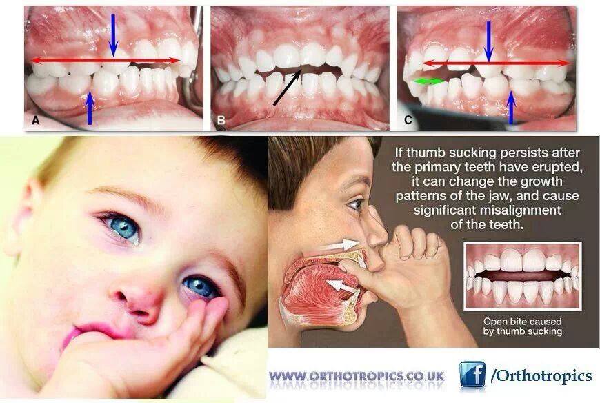 thumb-sucking-and-speech-disorders-brisbane-speech-pathology-kids